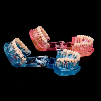 Naują Dantų Implantai Dantų Ligos Modelis Su Restauravimo Tiltas Dantų Odontologas Medicinos Mokslo Dantų Ligos Mokymo Studijų