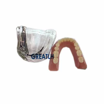 Overdenture Dantų implantas remonto modelis keičia apatinio žandikaulio, su Mėlyna juosta Dantų Mokymo dantų mokykloje